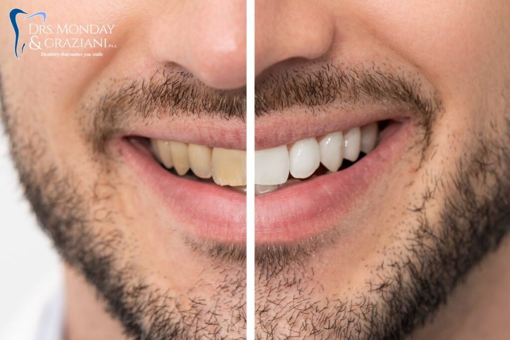 Teeth whitening Charleston 