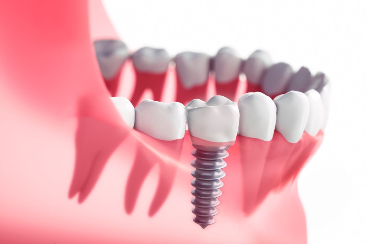 dental implants charleston