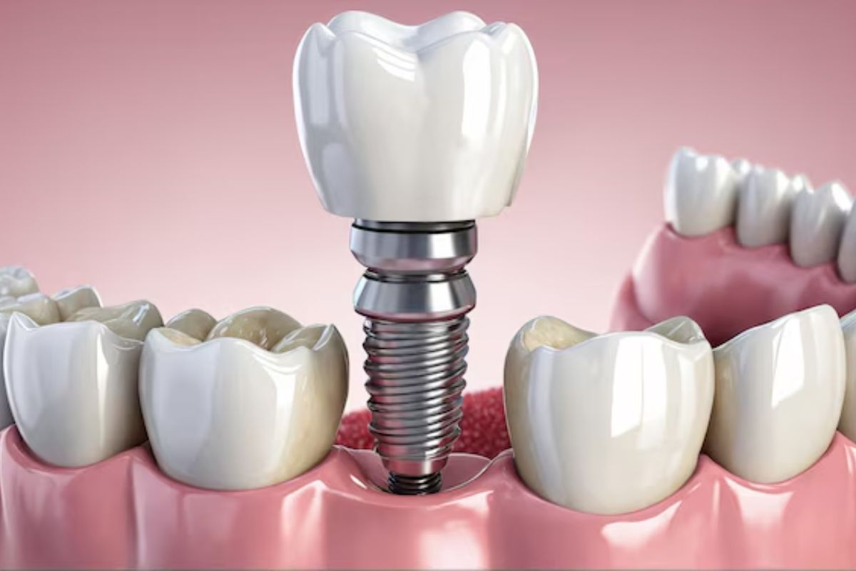 dental implants in charleston
