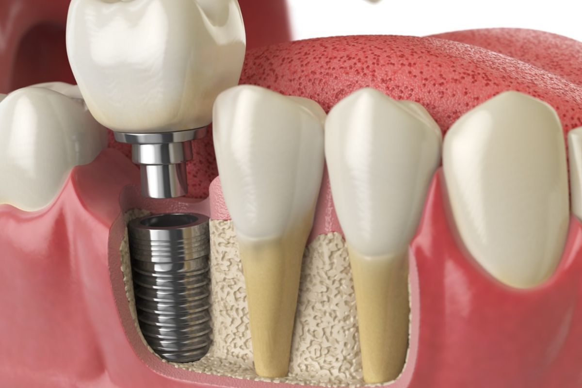 dental implants charleston