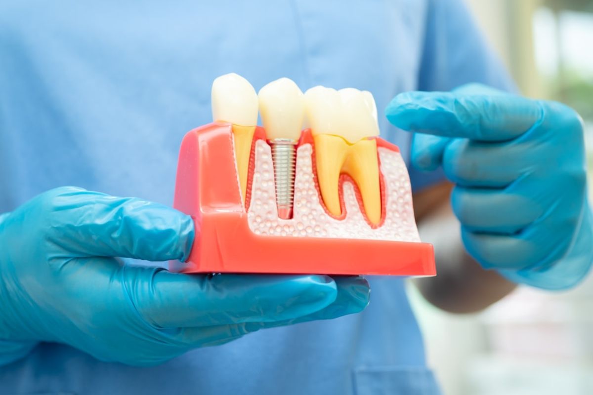 dental implants charleston