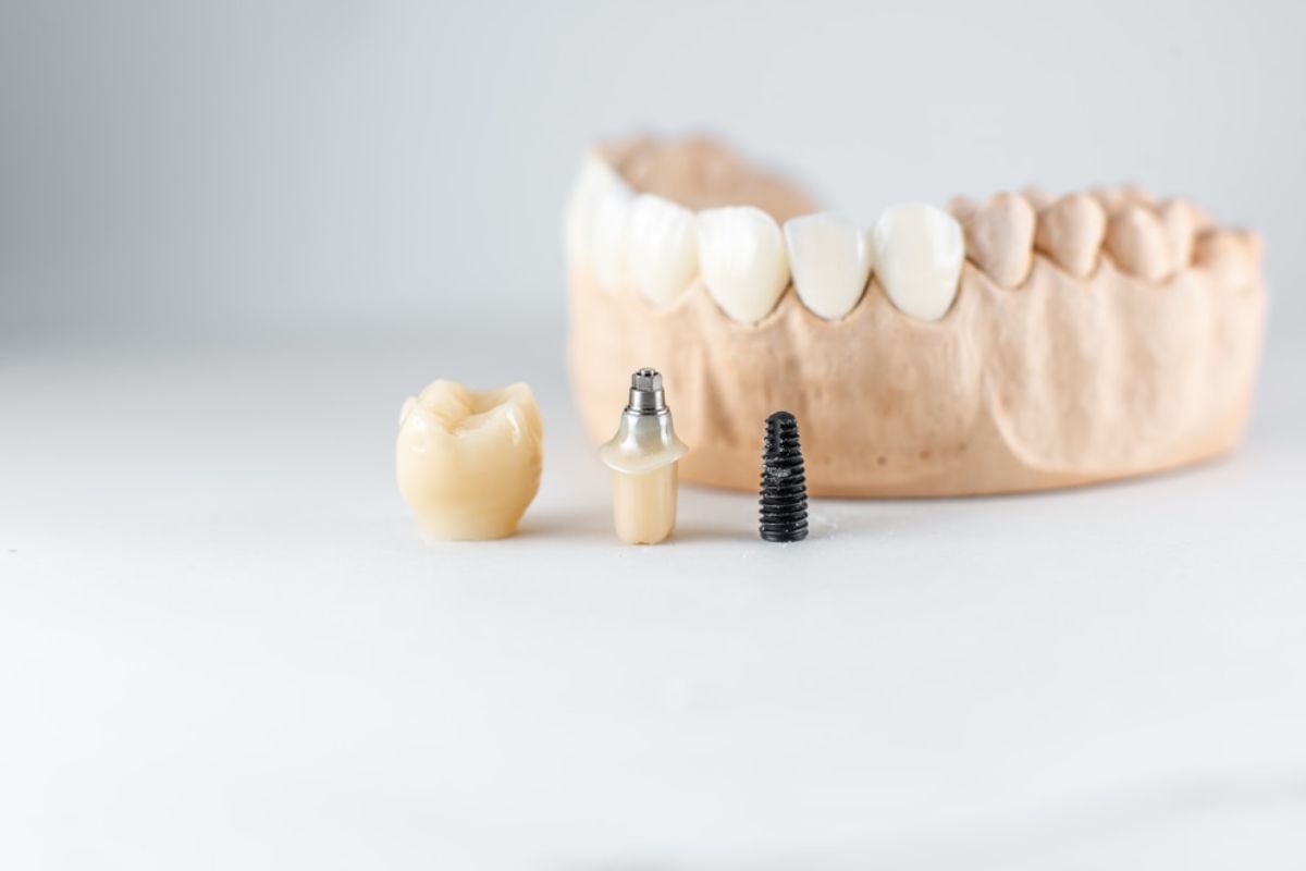 dental implants in Charleston