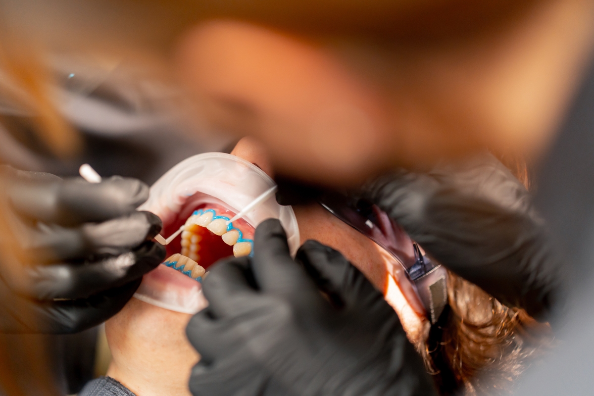 Teeth Whitening Charleston
