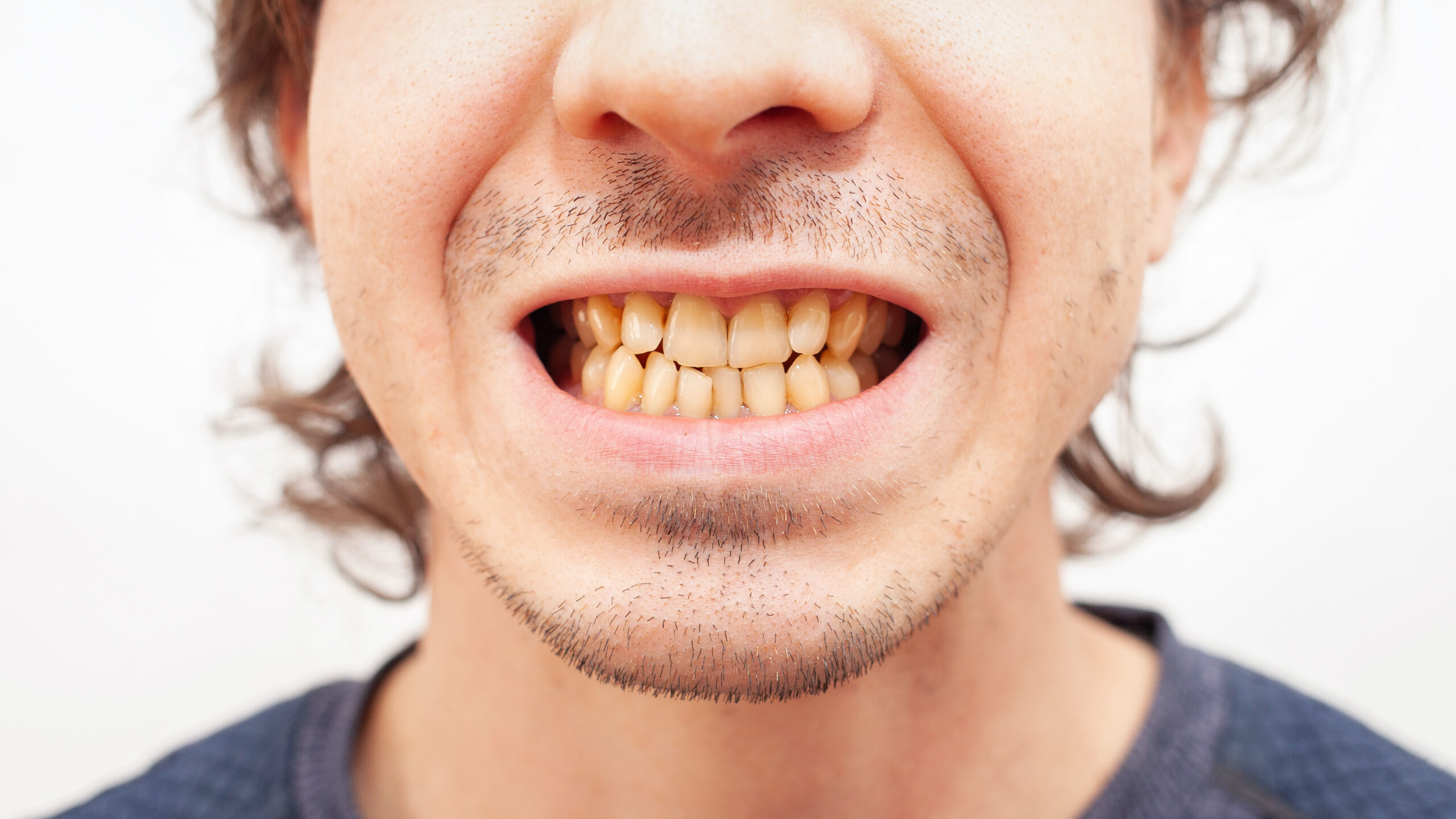 Close-up of yellow, stained teeth showing common tooth discoloration caused by aging, diet, and lifestyle habits before whitening treatment.