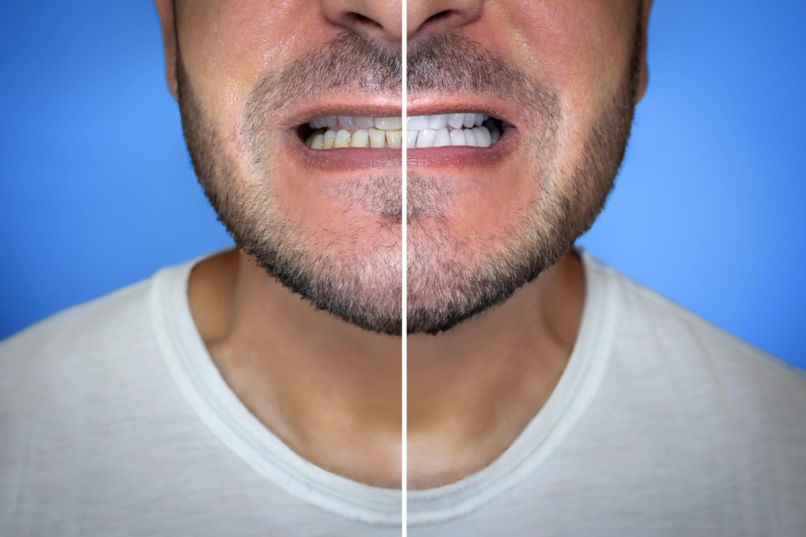 Before and after comparison of teeth whitening showing yellow stained teeth on the left and brighter white teeth on the right.