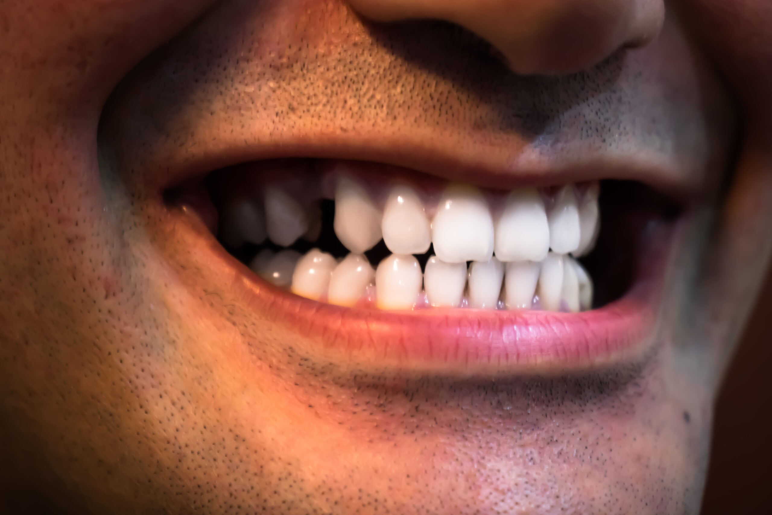 Close-up image of a mouth showing missing teeth and uneven spacing