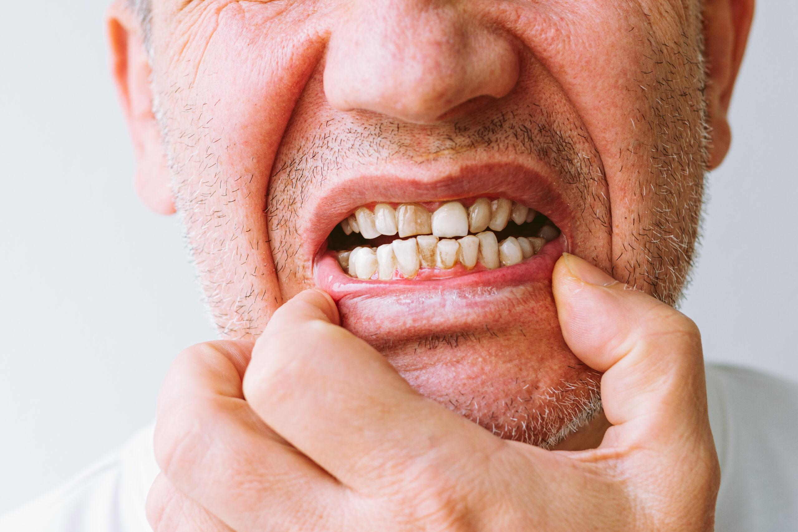 Close-up of a man pulling down his lower lip to show dark spots and tartar buildup on teeth, illustrating common causes of tooth discoloration