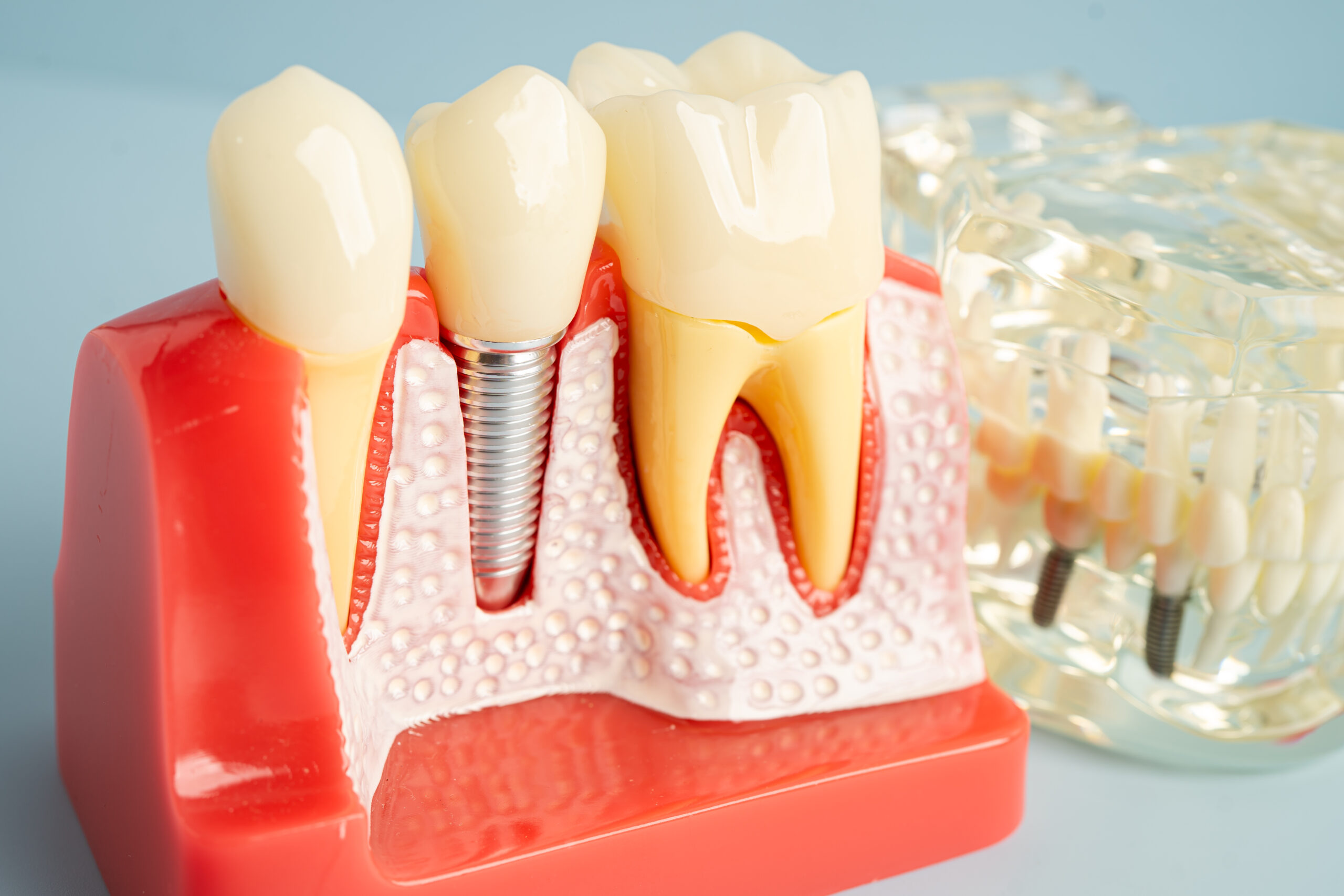 Dental professional holding a model of a dental implant with crown to explain tooth replacement and healing process