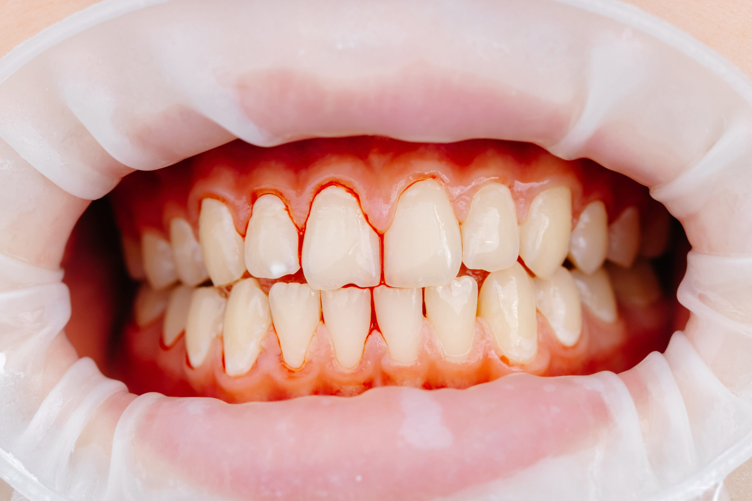 Close-up view of inflamed gums and teeth showing redness and bleeding along the gumline during a dental examination